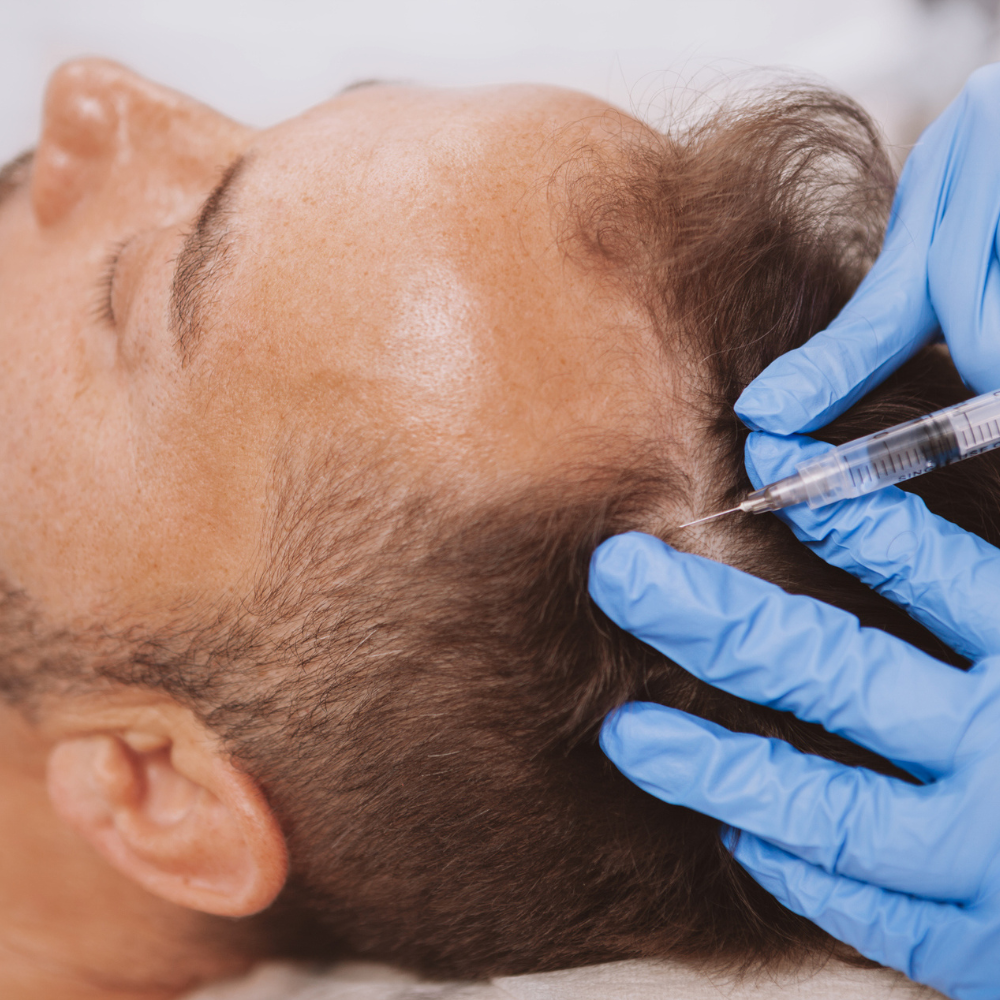 There May Not Be a Baldness *Cure* Yet But There Are Definitely Treatments